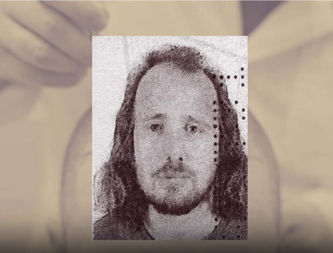 shkoi-ne-turqi-per-te-mbjelle-floket-vdes-pas-transplantit-36-vjecari-shqiptar